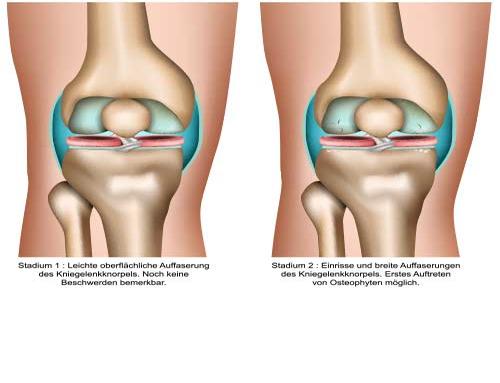 Stadien der Arthrose