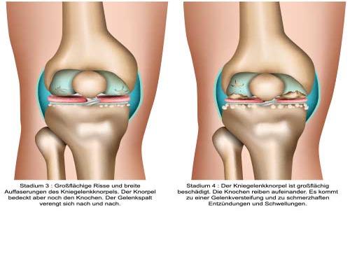 Arthrose - Knie Stadien