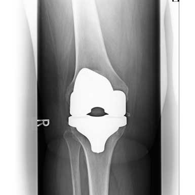 Knie - Schlittenprothese