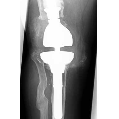 Knie - Teilgekoppelte und gekoppelte Prothesen