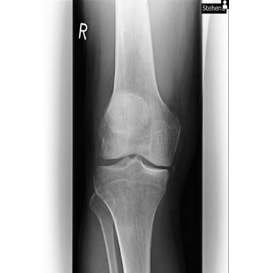Knie - Röntgenaufnahme