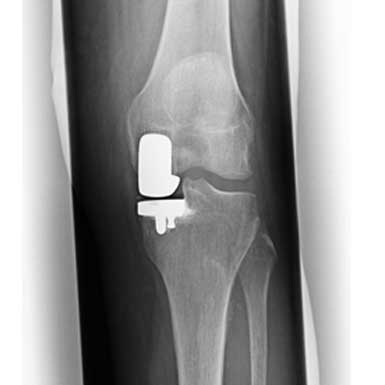 Knie - Schlittenprothese