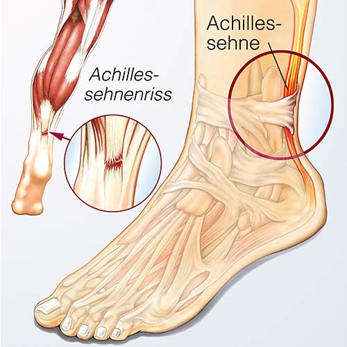Achillessehne