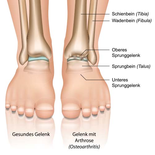Arthrose Sprunggelenk