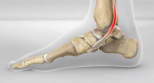 Tibialis - Posterior - Sehne