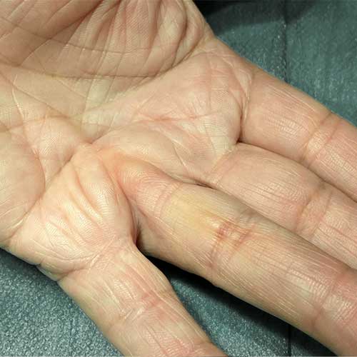 Eingezogene Finger - Morbus Dupuytren