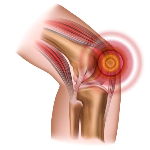 Patellaspitzensyndrom