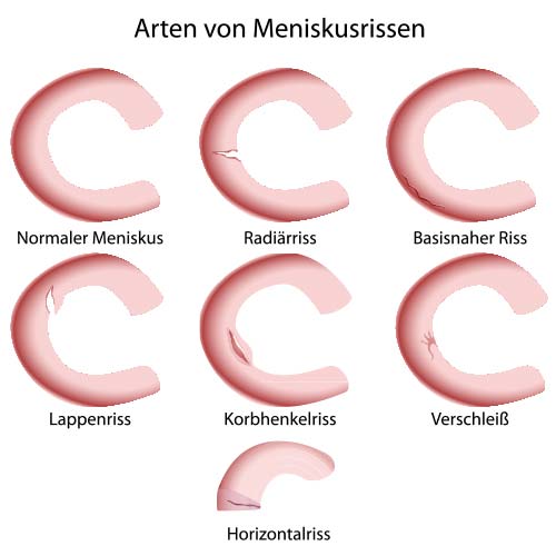 Arten von Miniskusrissen