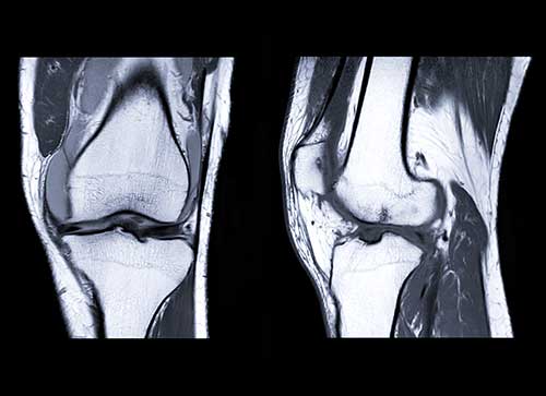 Gelenkmaus Osteochondrosis dissecans