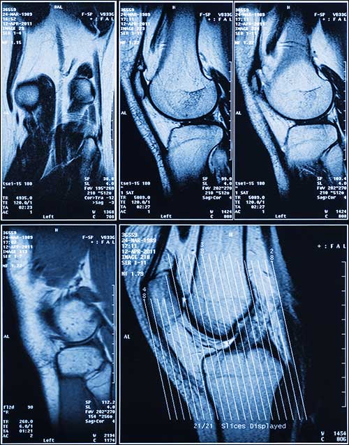 Überlastung - Bone Bruise