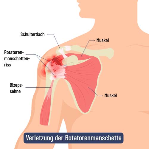 Rotatorenmanschette Bizepssehne
