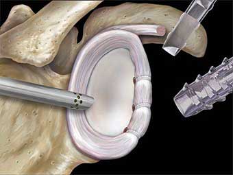 Schulterluxation