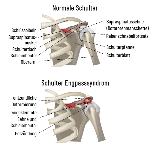 Engpaßsyndrom Impingemnt
