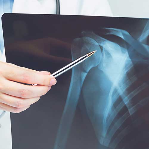 Arthrose in der Schulter