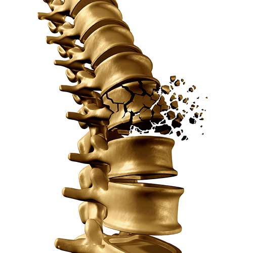 Osteoporose