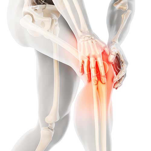 Arthrose - Knie